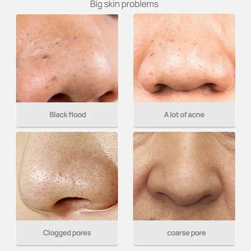 White Blackhead Remover Nose Mask - Givenco